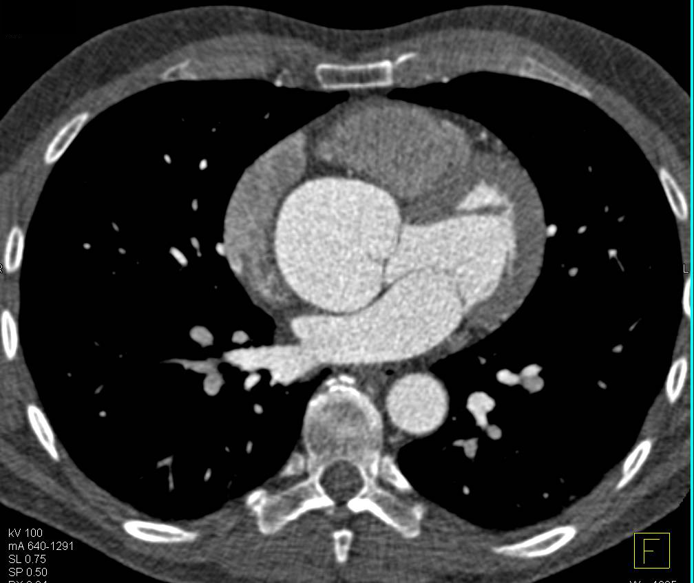 Dilated Aortic Root in Marfan Syndrome - CTisus CT Scan