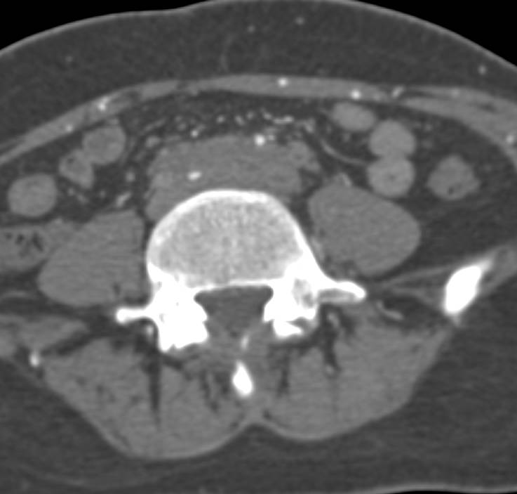 Retroperitoneal Fibrosis with occlusion of the Abdominal Aorta with Extensive Collaterals - CTisus CT Scan