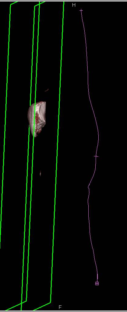 CTA Runoff with Automated Bone Removal and Vessel Tracking - CTisus CT Scan