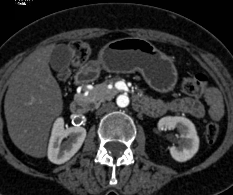 Median Arcuate Ligament Syndrome with Narrowed Celiac Artery and Prominent Gastroduodenal Artery (GDA). Right Renal Artery Aneurysm is Present - CTisus CT Scan