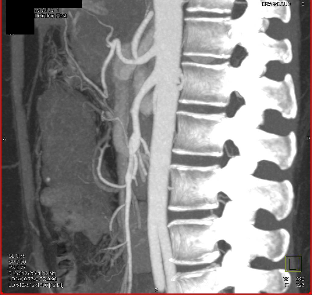 Aneurysm of Superior Mesenteric Artery (SMA) and Left Anterior Tibial Artery in a Patient with Ehlers-Danlos Syndrome - CTisus CT Scan