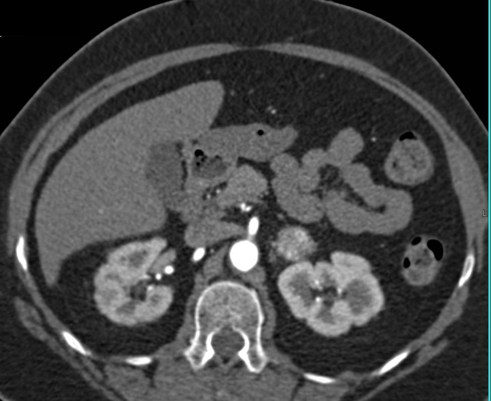 Focal Dissection of the Left Superficial Femoral Artery (SFA) in Patient with Peripheral Vascular Disease (PVD) - CTisus CT Scan