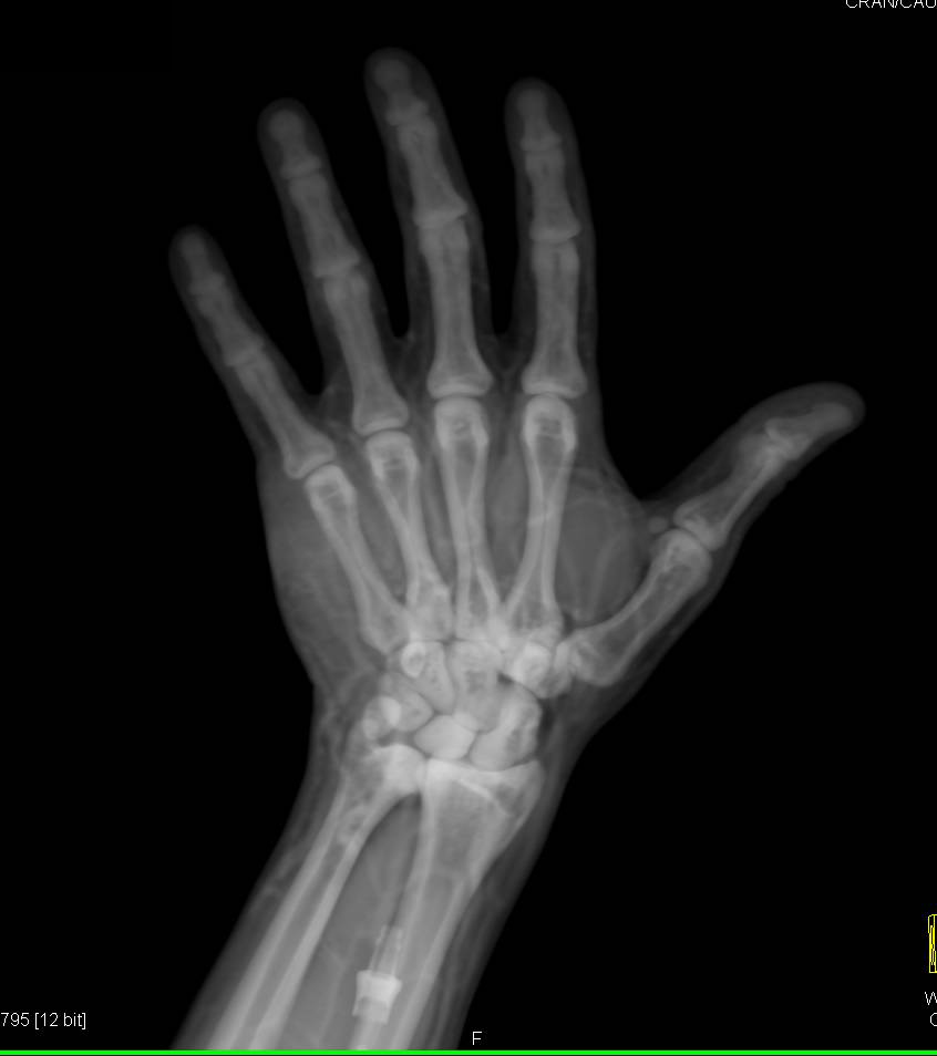 Beautiful CTA of the Hand with IV in Place in Multiple 3D Views - CTisus CT Scan