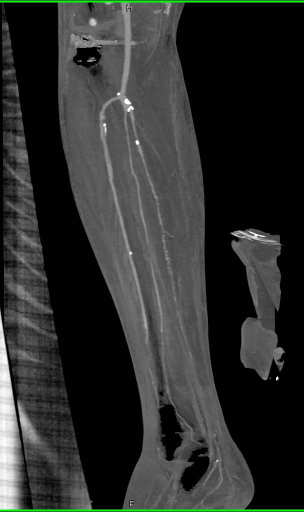 Disease in Trifurcation Vessels - CTisus CT Scan
