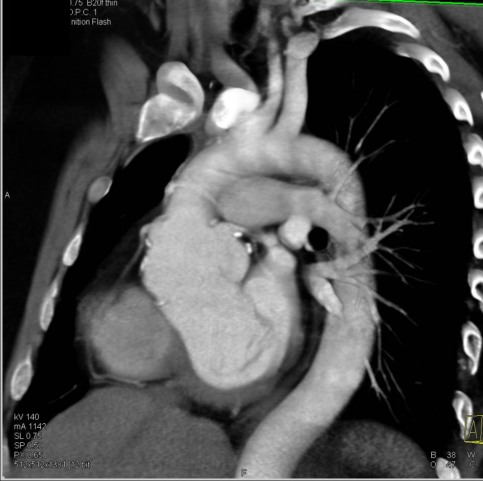 Marfan Syndrome with Dilated Sinus of Valsalva - CTisus CT Scan