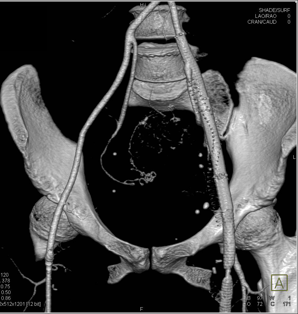 Near Occlusion Short Segment of Stent in Left Superficial Femoral Artery (SFA) - CTisus CT Scan