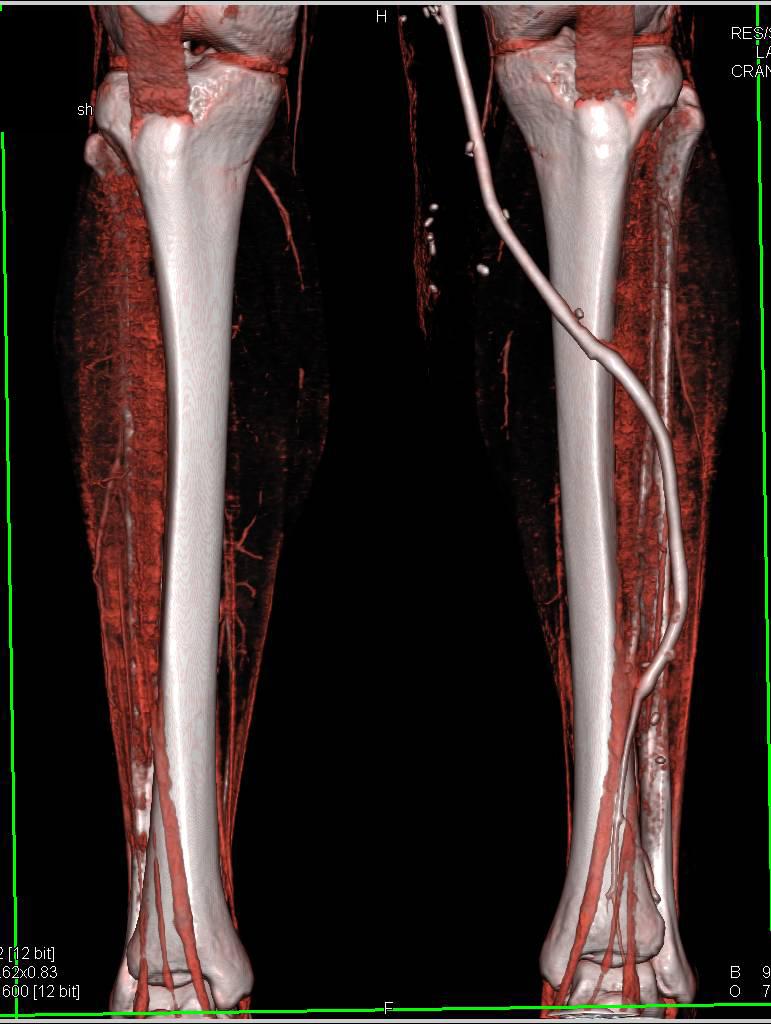 Superficial Femoral Artery (SFA) to Posterior Tibial Artery Bypass - CTisus CT Scan