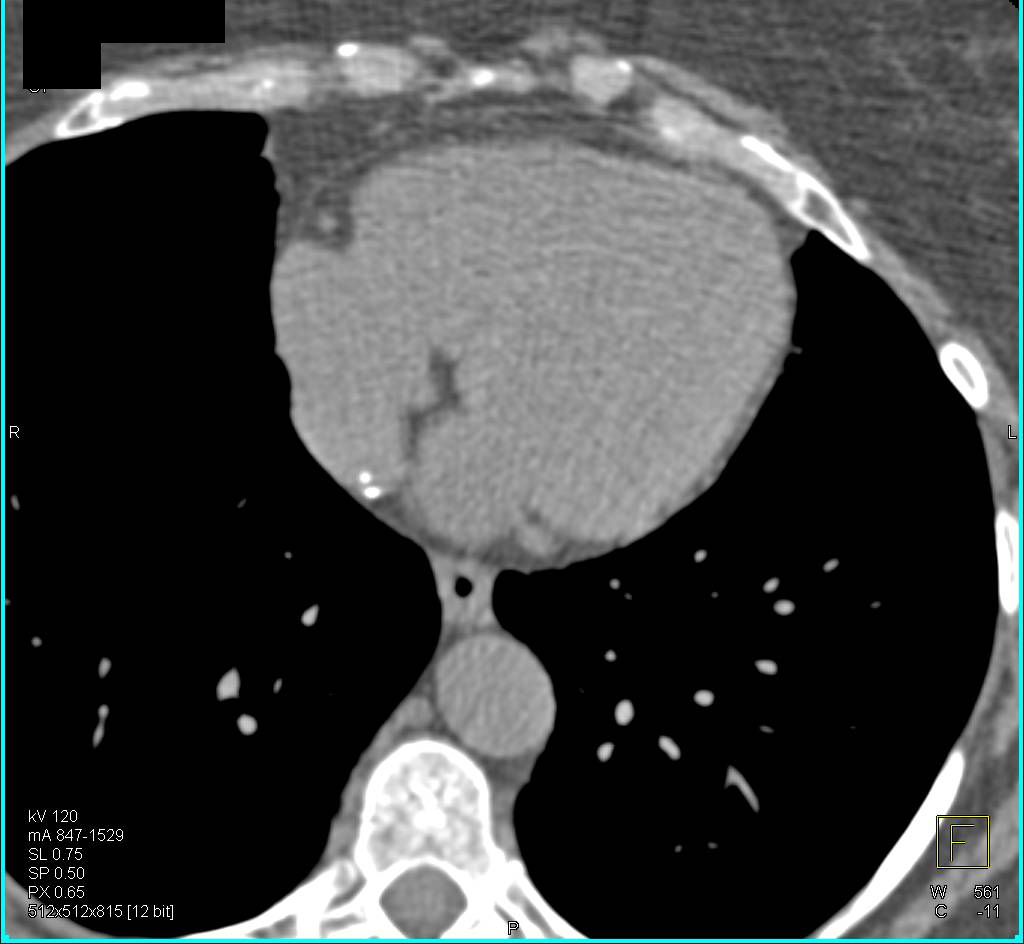 Partially Calcified Thrombus Inferior Vena Cava (IVC) Near Right Atrial Junction - CTisus CT Scan