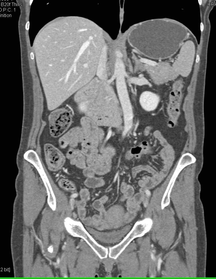 Prominent Gastroduodenal Artery (GDA) in a Patient with MALS (Median Arcuate Ligament Syndrome) - CTisus CT Scan