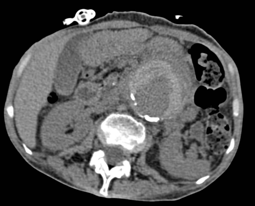 Pending Rupture of an Abdominal Aortic Aneurysm with High Density Rim Sign - CTisus CT Scan