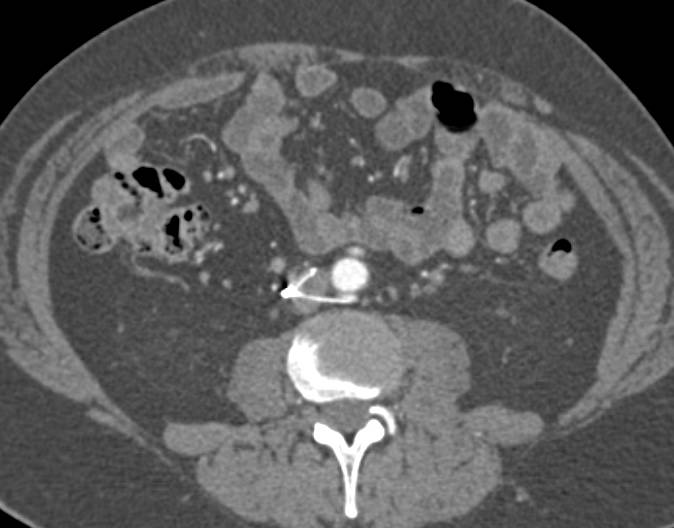 Malpositioned Inferior Vena Cava (IVC) Filter - CTisus CT Scan