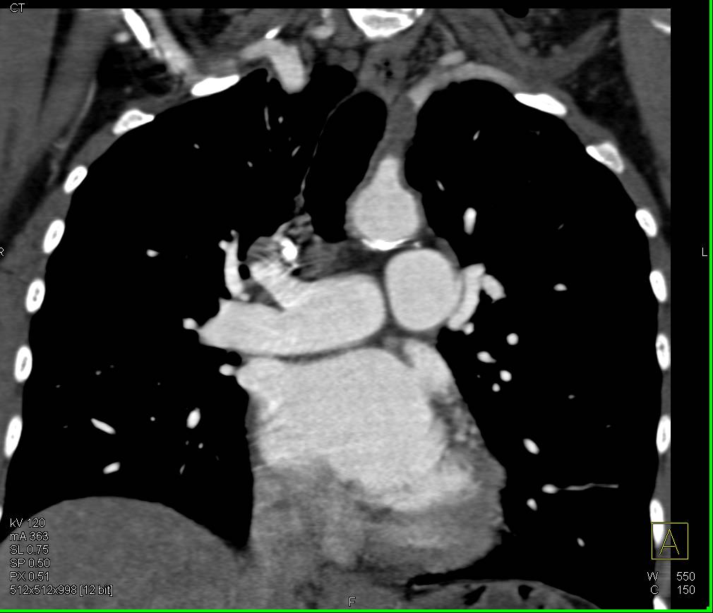 Short Segment Occlusion of the Left Subclavian Artery - CTisus CT Scan