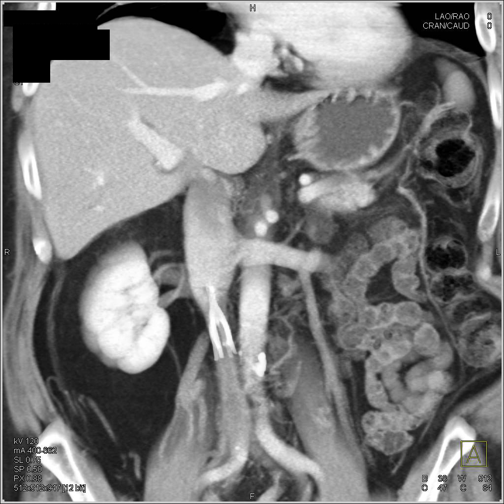 Inferior Vena Cava (IVC) Filter with Clot in IVC - CTisus CT Scan