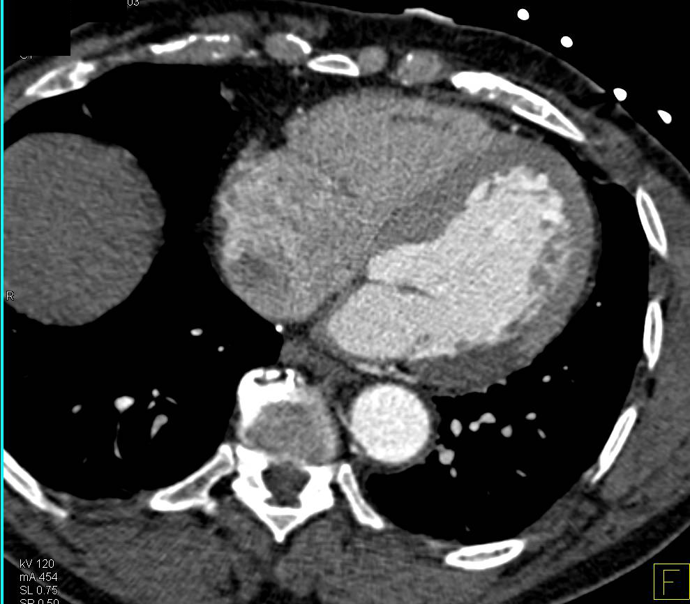 Normal Arterial Anatomy in Upper Extremity - CTisus CT Scan