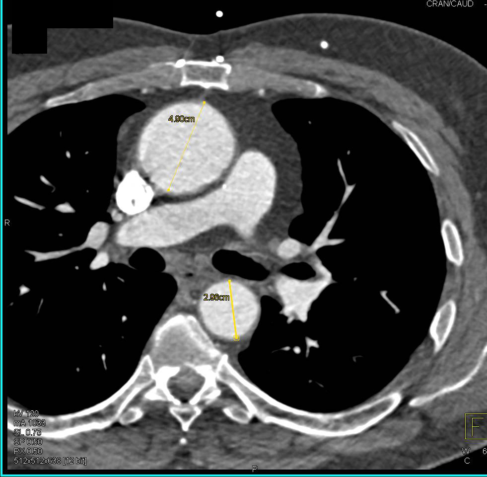 Dilated Ascending Aorta with Volume Measurements and Vessel Tracking - CTisus CT Scan
