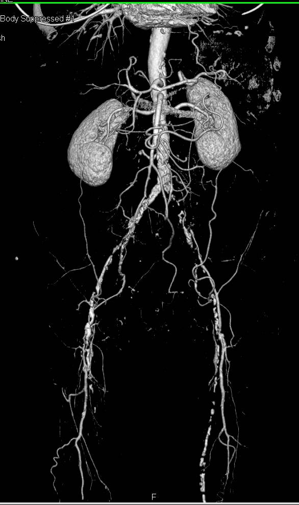 Dual Energy Run Off Study with Vascular Disease at Multiple Sites but Especially in the Superficial Femoral Artery (SFA)'s Bilaterally - CTisus CT Scan