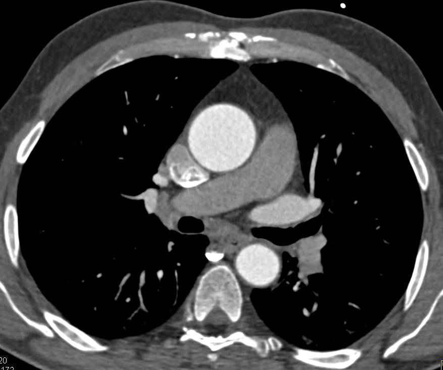 how to measure ascending aorta on ct