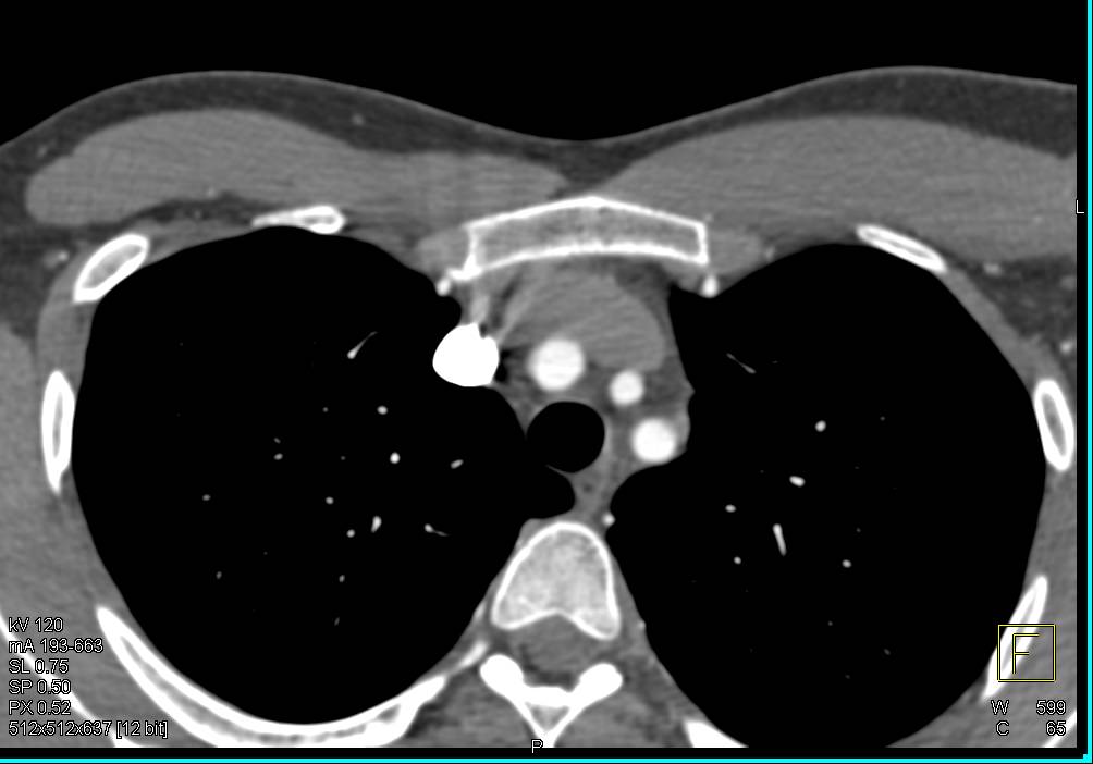 Vascular Stent from Left Subclavian Artery to the Left Brachial Artery - CTisus CT Scan