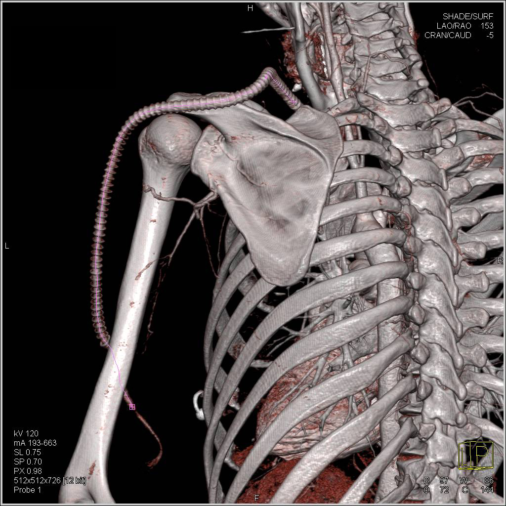 3D Demonstration of Subclavian Artery to Brachial Artery Graft - CTisus CT Scan