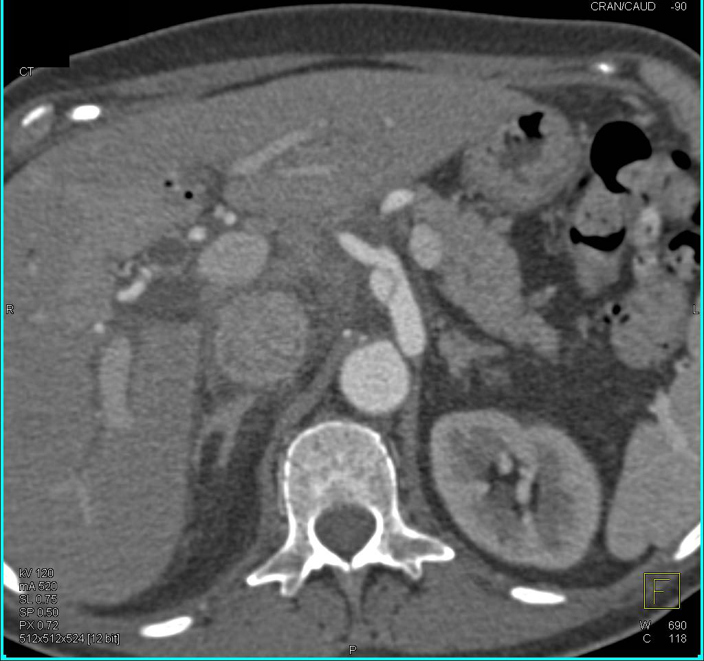 Focal Dissection in the Celiac Artery - CTisus CT Scan