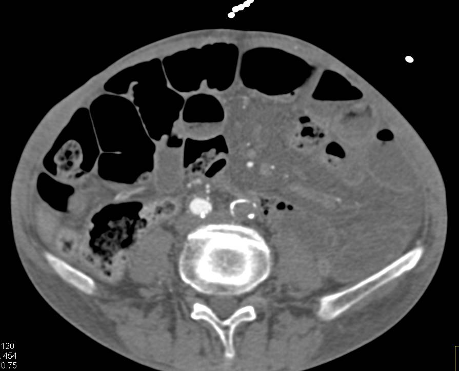 Occluded Left Common Iliac Artery with Bypass Graft - CTisus CT Scan