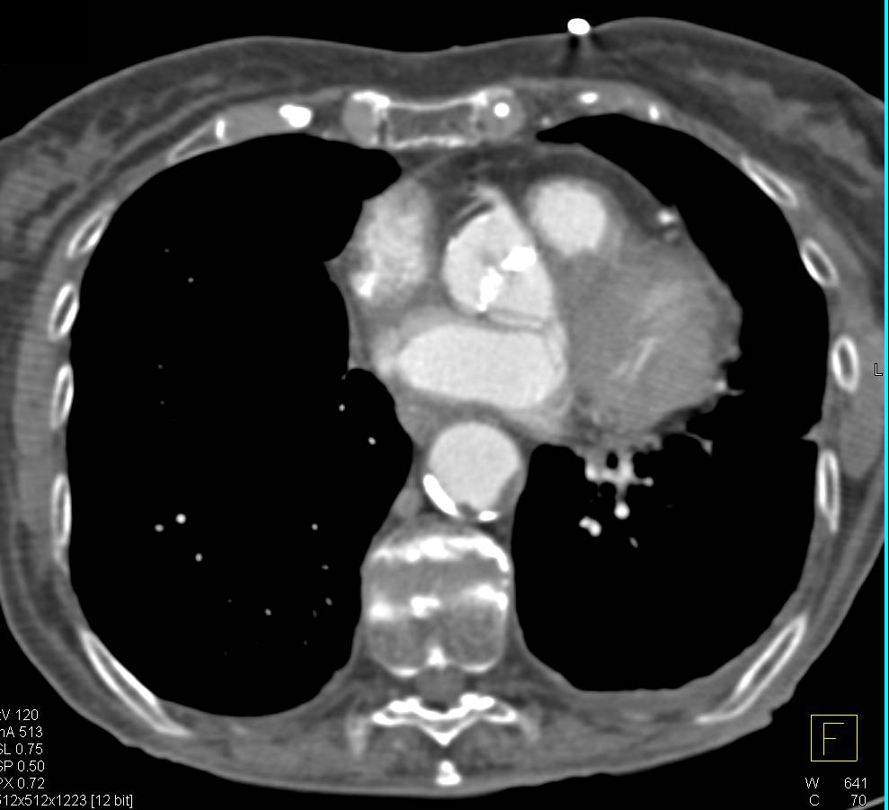Abdominal Aortic Aneurysm - CTisus CT Scan