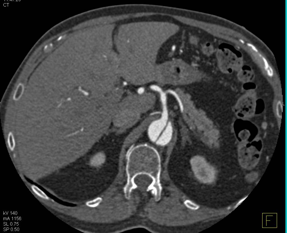 3D of a Type B Dissection - CTisus CT Scan