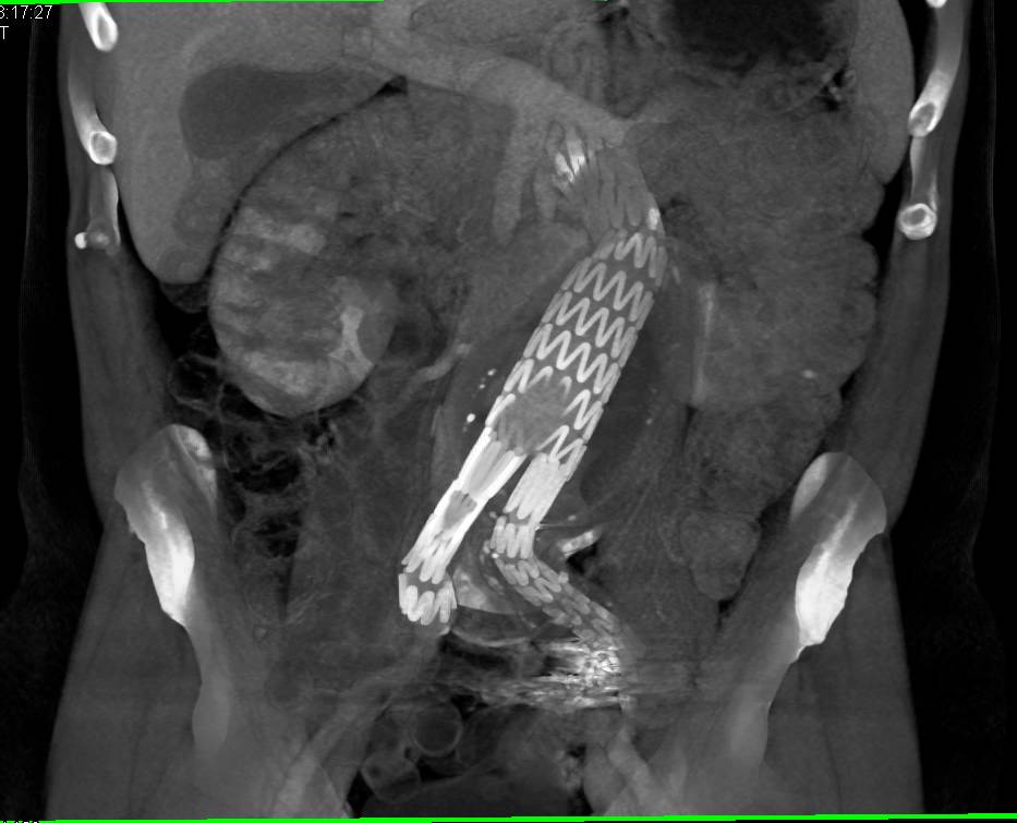 Endovascular Stent Using Color Coding - CTisus CT Scan