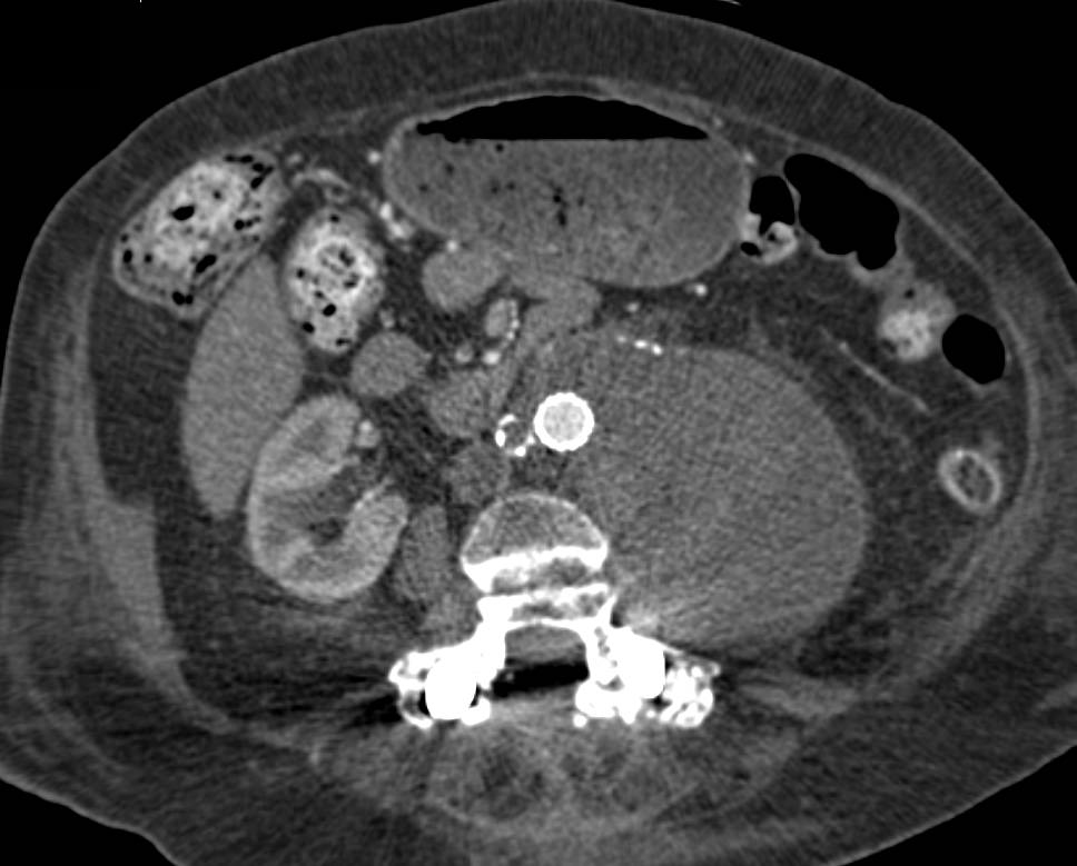 Aortic Aneurysm with Occluded Left Common Iliac Artery with Fem-Fem Graft - CTisus CT Scan
