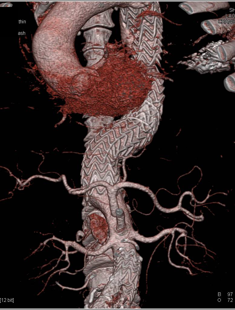 3D of Thoracic Endovascular Stent - CTisus CT Scan