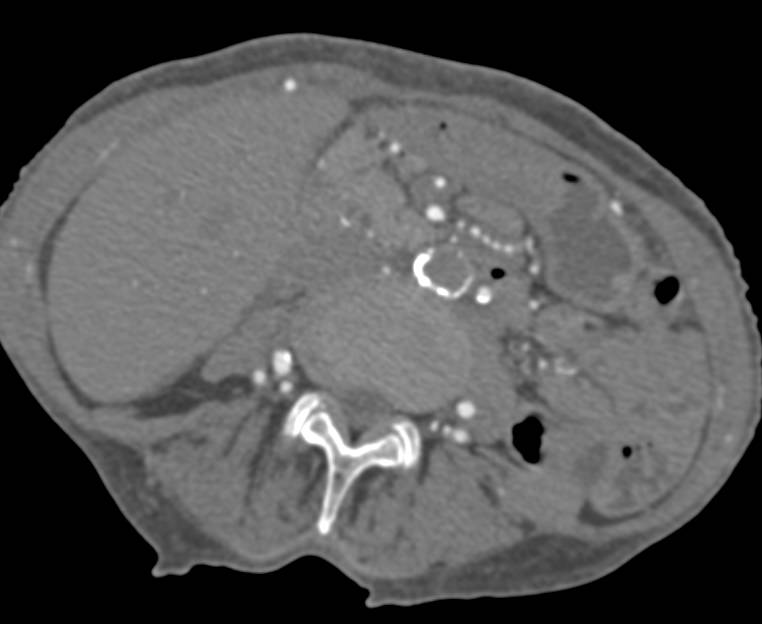 Occluded Abdominal Aorta with Collaterals - CTisus CT Scan