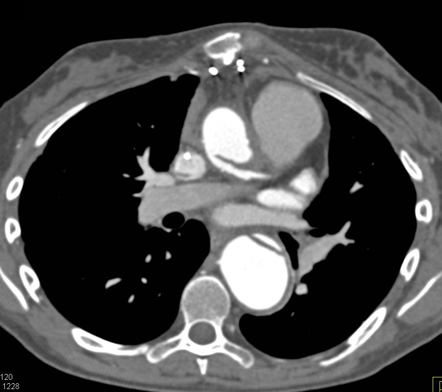 Type B Dissection Extends into the Abdominal Aorta - CTisus CT Scan