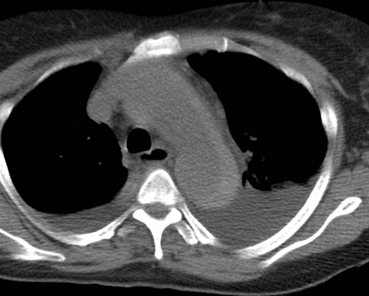 Intramural Hematoma Nicely seen on Non-contrast CT - CTisus CT Scan
