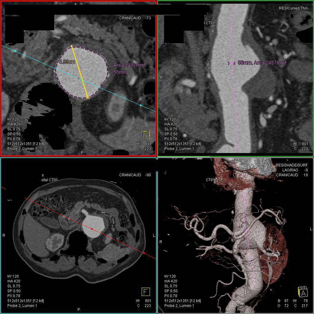 Analysis in 3D of an Abdominal Aortic Aneurysm with Key Vessels off the Aneurysm - CTisus CT Scan