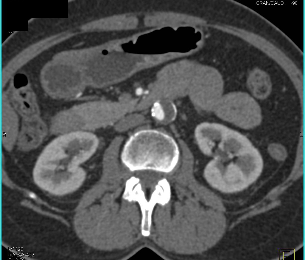 Aortic Aneurysm with Bleed Treated with Stents (see all 3 C timepoints) - CTisus CT Scan
