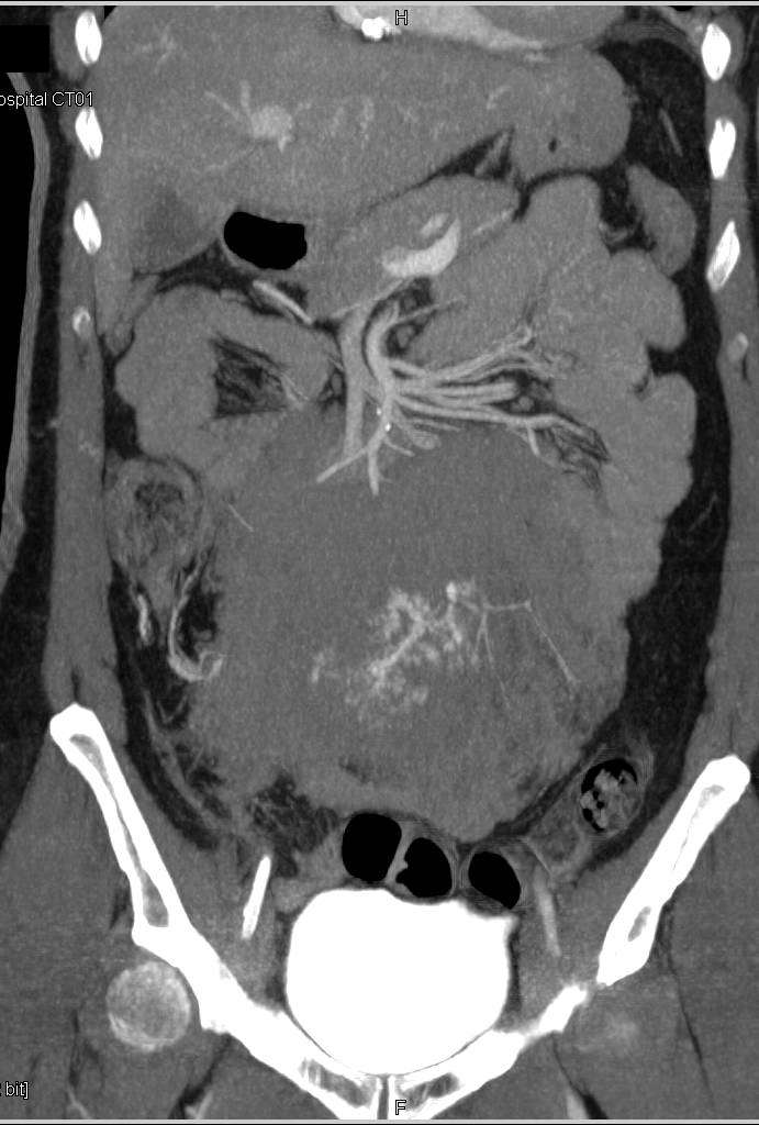 Impressive Retroperitoneal Fibrosis with Encasement and Arterial Stents - CTisus CT Scan