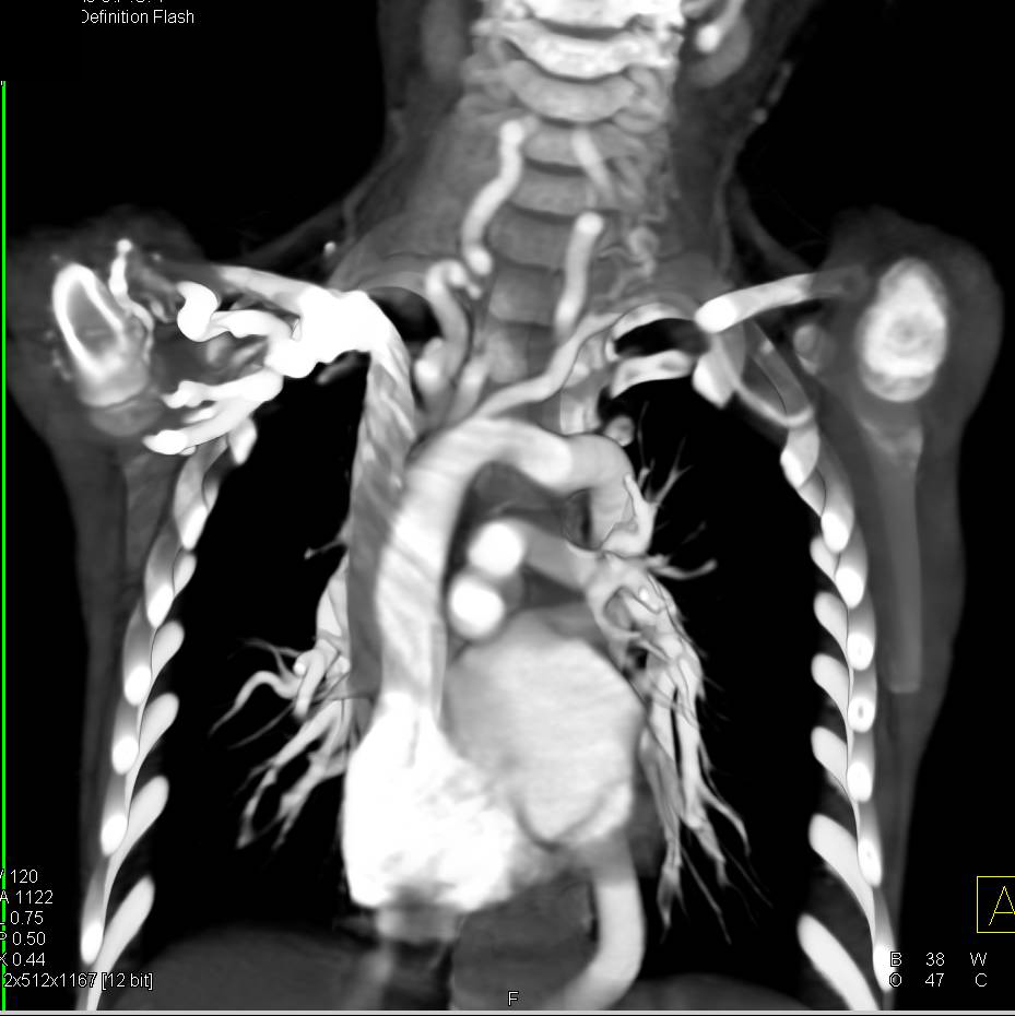 CTA in Loeys-Dietz Syndrome with Vascular Tortuosity in Head and Neck Vessels and Thoracic and Abdominal Aorta - CTisus CT Scan