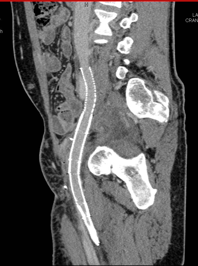 CTA with Right Iliac Venous Stent which Narrows - CTisus CT Scan