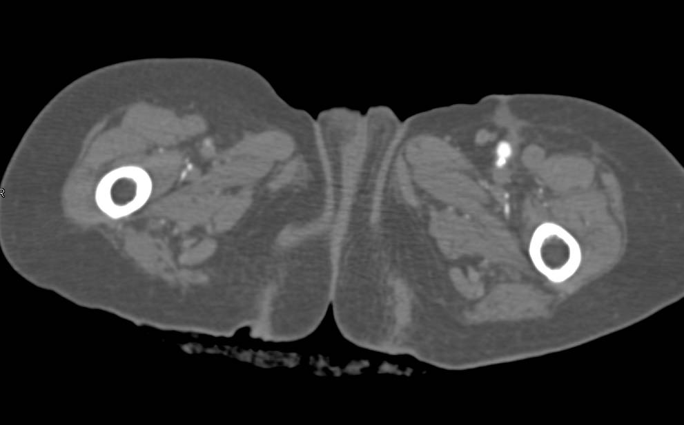 3D Map of Left Axillary to Superficial Femoral Artery (SFA) Graft withe SFA Disease - CTisus CT Scan