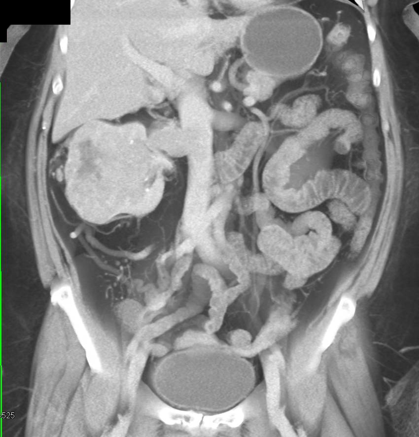 Clear Cell renal Cell Carcinoma with Renal Vein and Inferior Vena Cava (IVC) Extension - CTisus CT Scan
