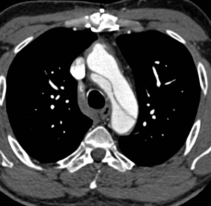 Type B Dissection Extends into the Right Common Iliac Artery - CTisus CT Scan