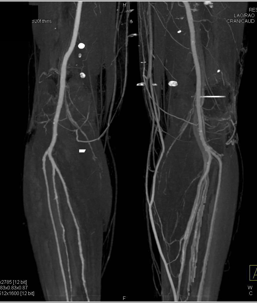 CTA Runoff with Early Flow to the Left Deep Venous System of the Calf - CTisus CT Scan
