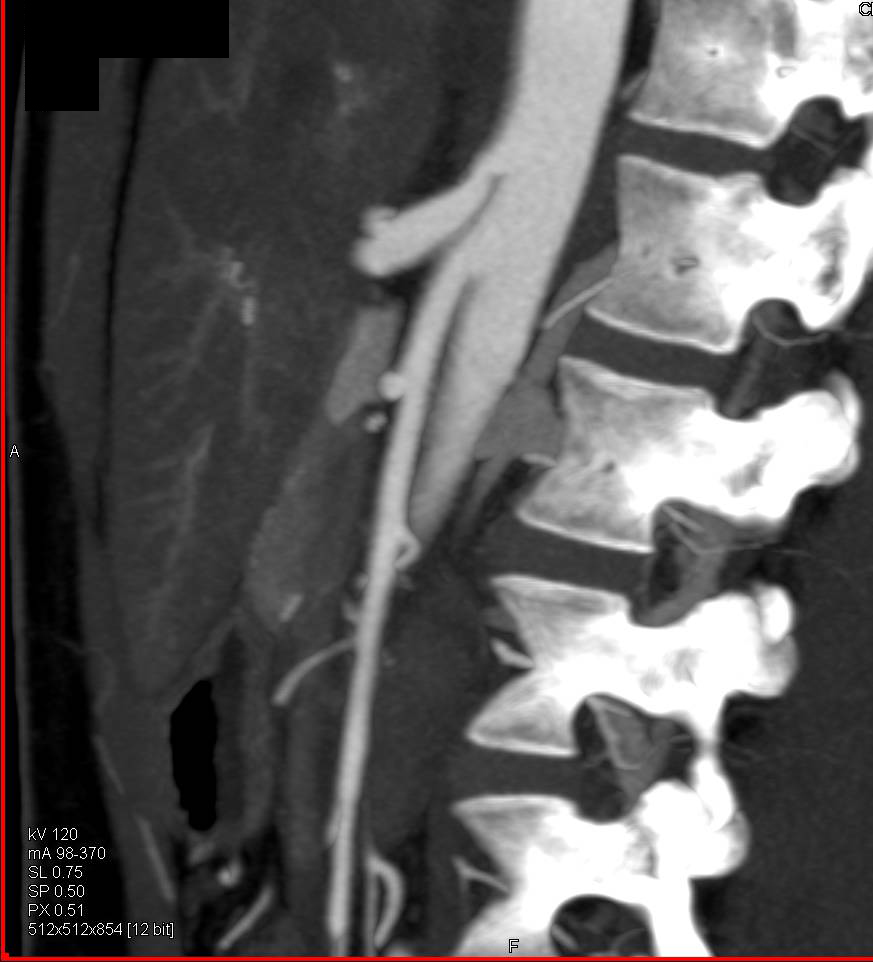 Superior Mesenteric Artery (SMA) Syndrome with Dilated Duodenum - CTisus CT Scan