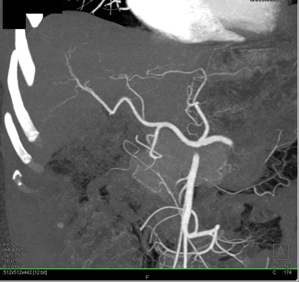 Normal Hepatic Artery - CTisus CT Scan