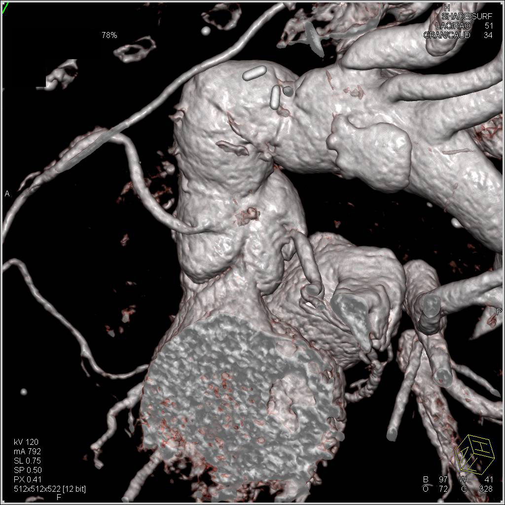 Aortic Dissection with Nice Definition of the True and False Lumen - CTisus CT Scan