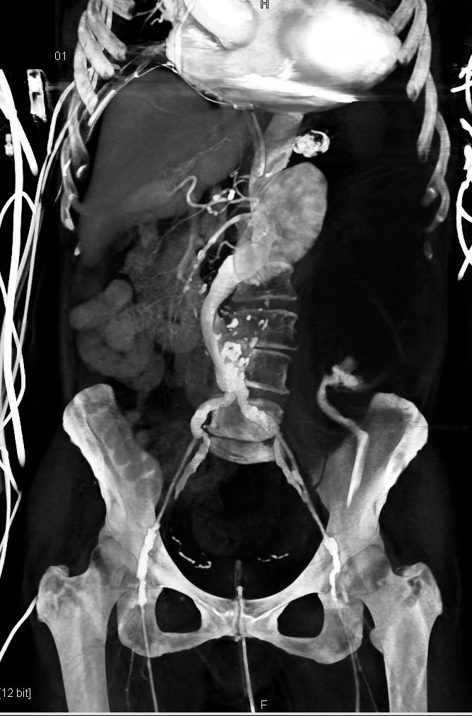Aortic Aneurysm with Extensive Thrombus Seen on 3D Maps - CTisus CT Scan