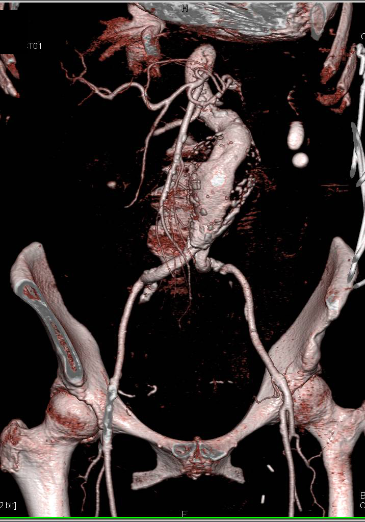Aortic Aneurysm and Retroperitoneal Hemorrhage - CTisus CT Scan