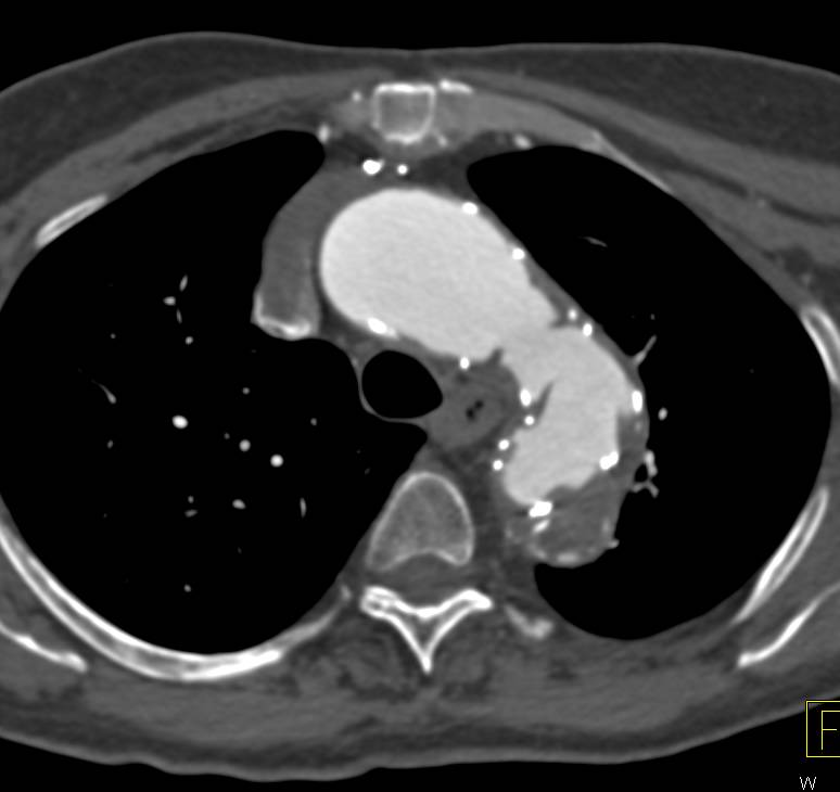 Endovascular Stent Placement in the Thoracic Aorta - CTisus CT Scan