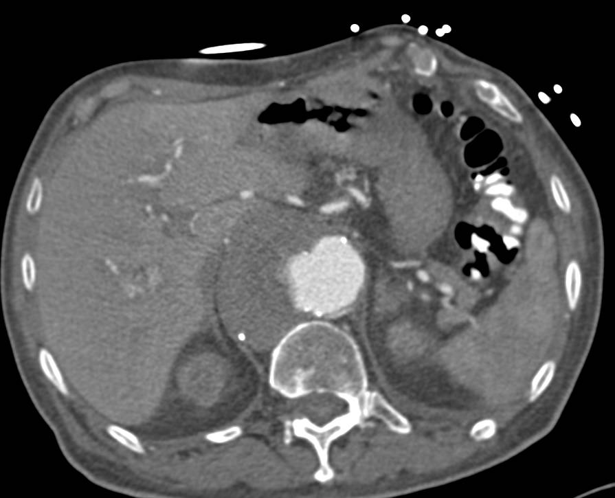 Aortic Aneurysm and Left Iliac Artery Aneurysm - CTisus CT Scan