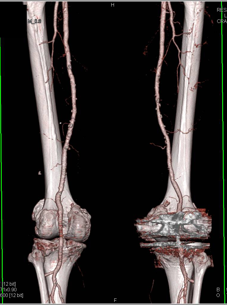 CTA Runoff with Peripheral Vascular Disease (PVD) and Artifact off Patient Total Knee Replacement (TKR) - CTisus CT Scan